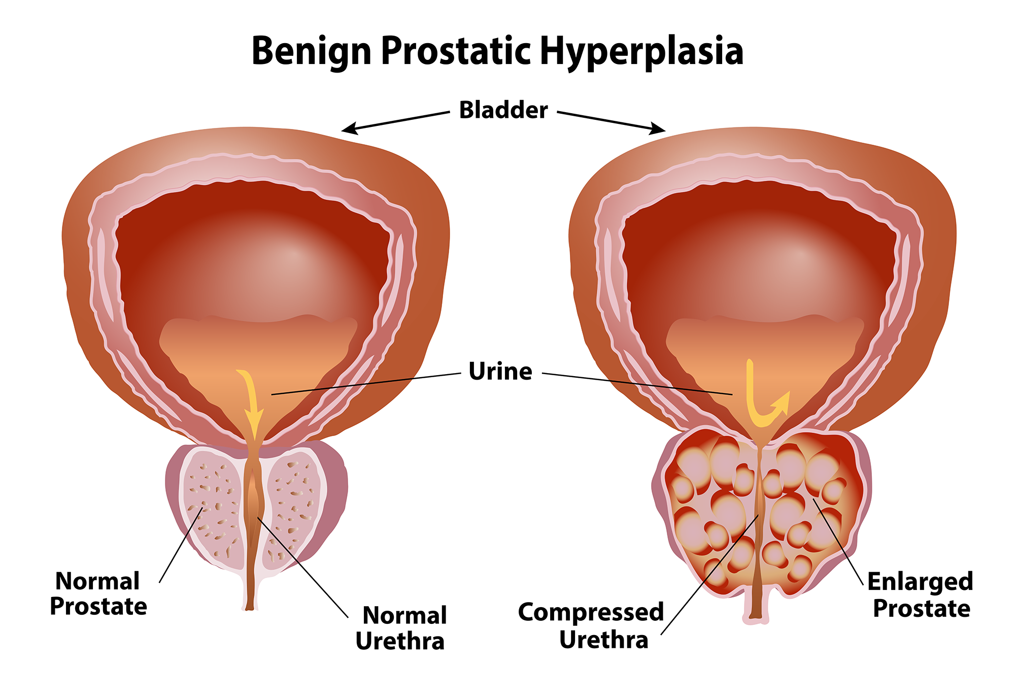 Common symptoms of BPH